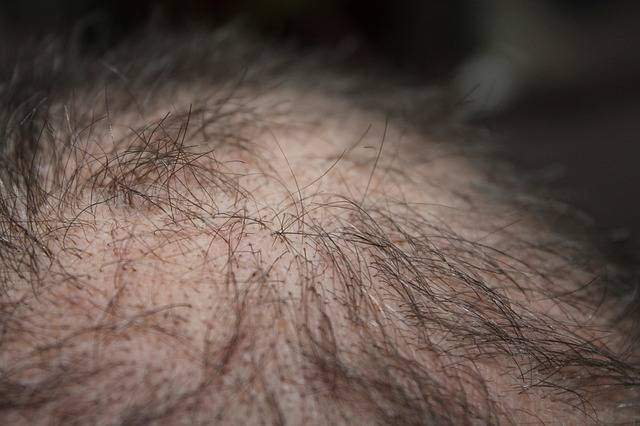 Reduce Hair fall in Men